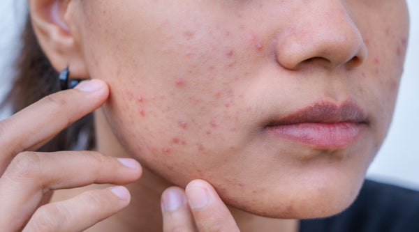 Natural ways to help Acne and troubled skin.
